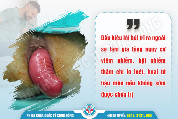 Búi trĩ sưng đau chảy máu là phải làm gì?