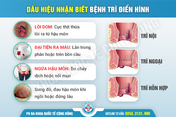 Hỗ trợ điều trị ngứa hậu môn như thế nào ở đâu cho an toàn và hiệu quả?