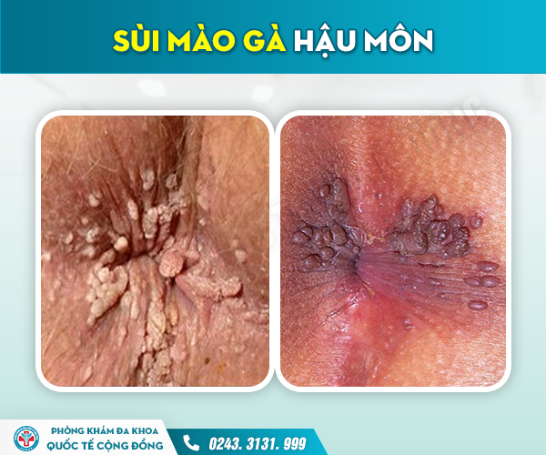 Chậm Trễ Chữa Sùi Mào Gà Hậu Môn: Nguy Cơ Ung Thư Hậu Môn Tăng Cao