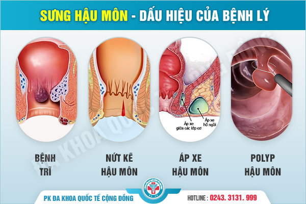 Sưng hậu môn – dấu hiệu điển hình của bệnh lý vùng hậu môn