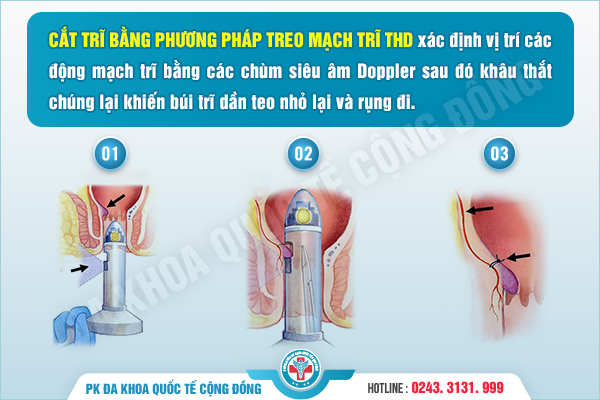 Chi Phí Phương Pháp Cắt Trĩ THD có đắt không?