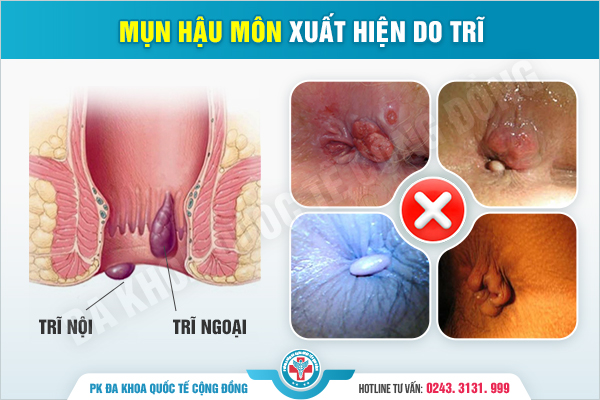 Đừng Bỏ Qua Mụn Ở Hậu Môn – Những Điều Bạn Cần Hiểu Rõ