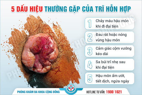 Trĩ hỗn hợp phức tạp, dễ nhầm với bệnh trĩ khác, cách phân biệt từ TS.BS Trịnh Tùng